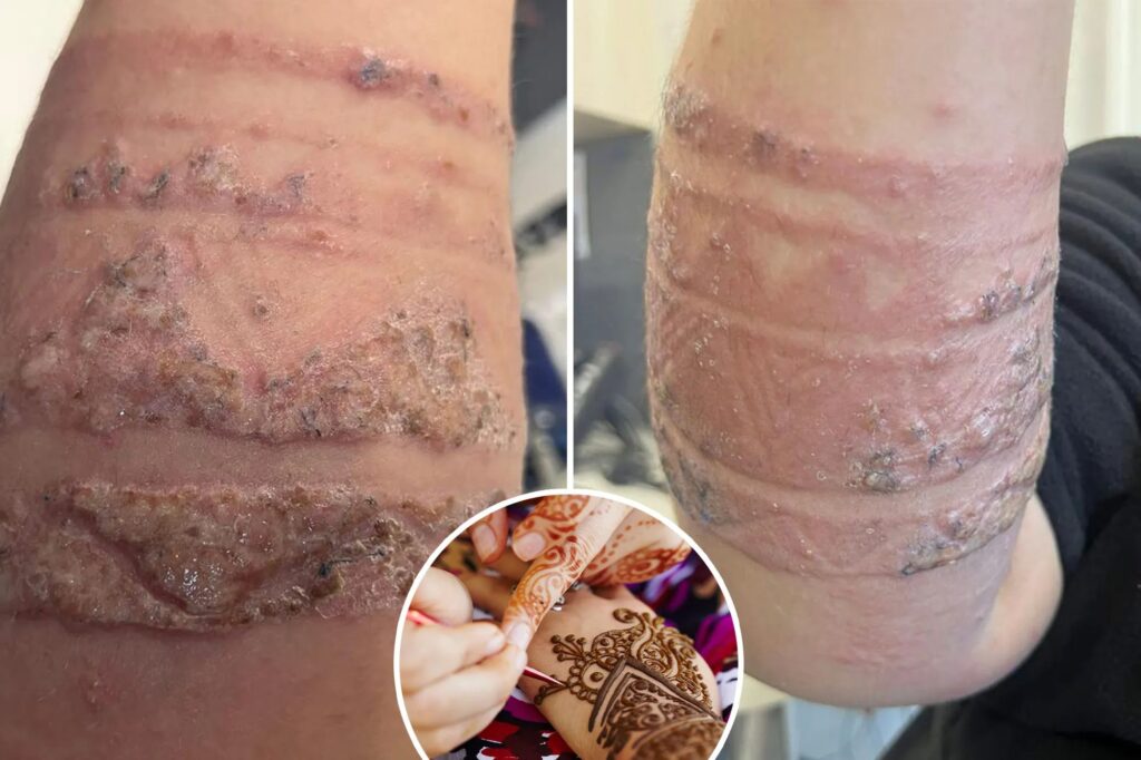 Mother exposes the horrific allergic reaction of the son's henna: "Commonally unfortunately"