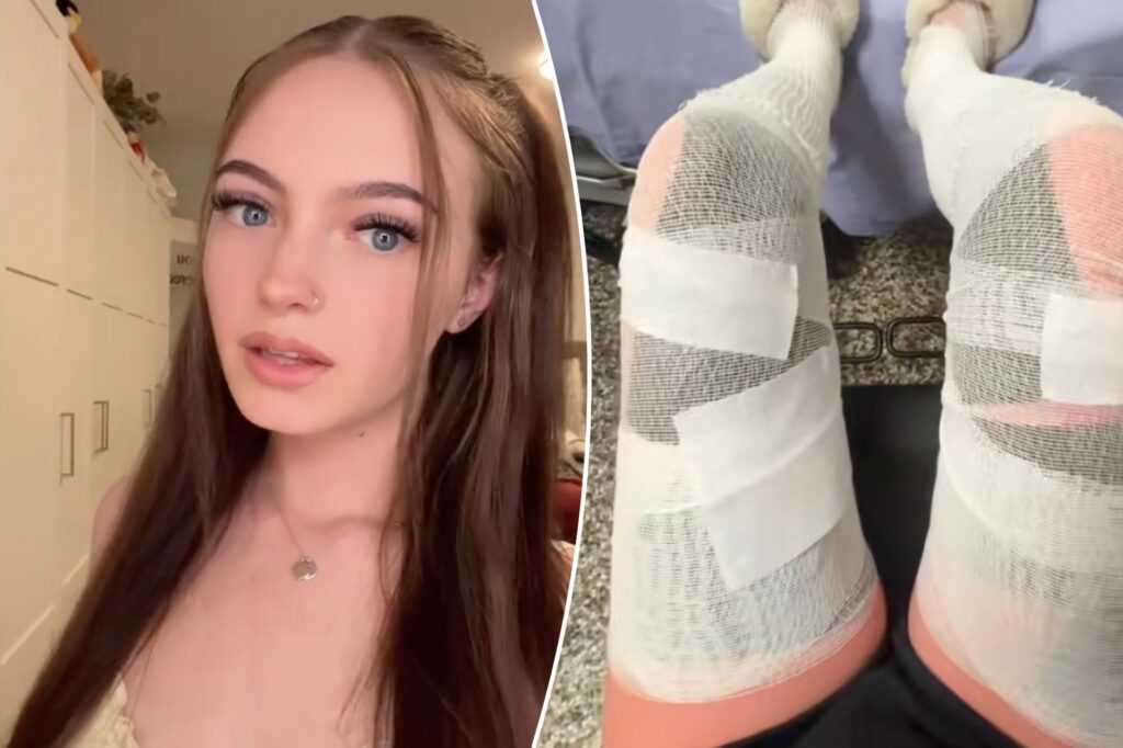 The woman left third degree burns and unable to walk for a week reveals her important mistake: "I will never forget this"